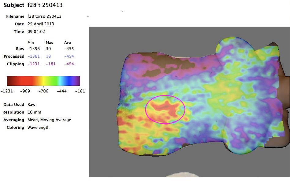 PCOS Ovarian Cyst Scan
