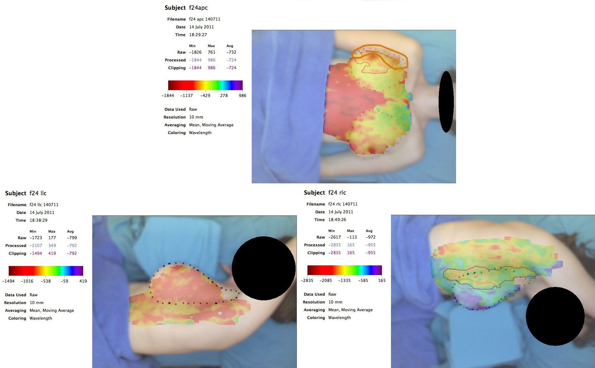 Post Lumpectomy Breast Scan