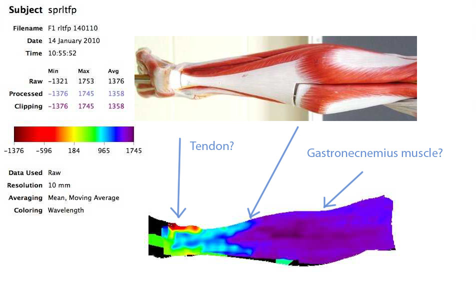 Scan chart indicating different tissue zones