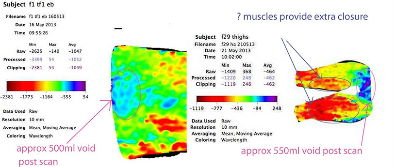 Incontinence Scan Comparison