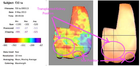 Kidney Transplant Scan