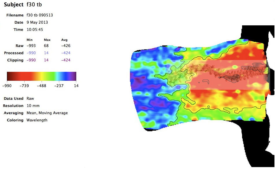 Scoliosis Spine Scan